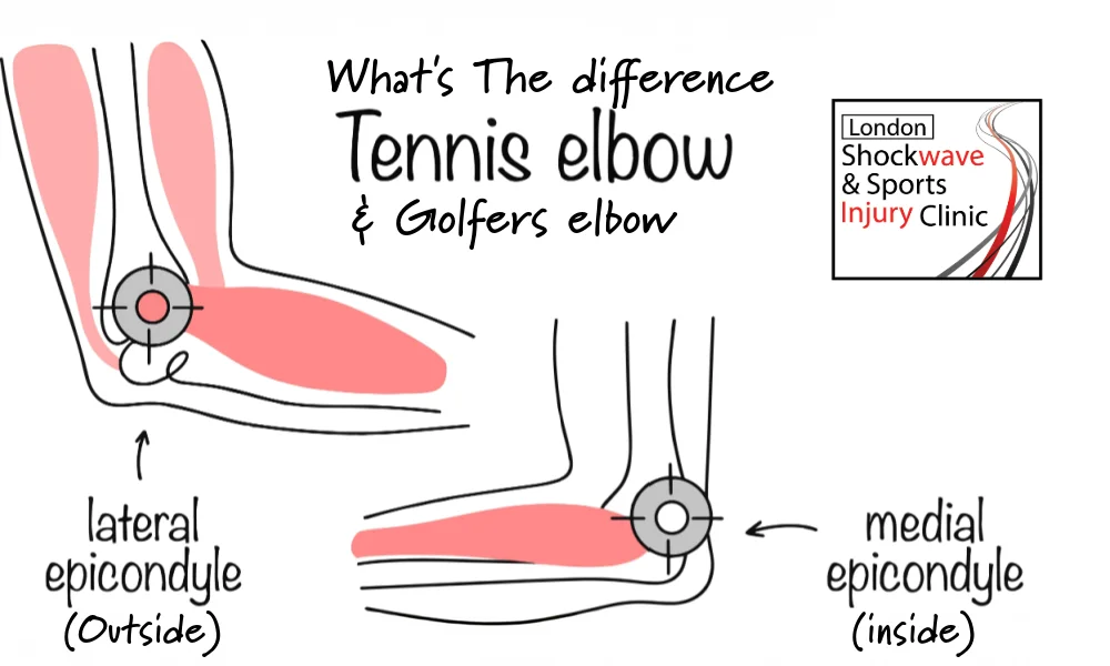 diffrences in tennis or golfers elbow treatment in wimbledon with shock wave therapy 
