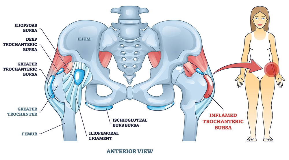 Can Shock Wave Therapy Help Hip Bursitis 8205