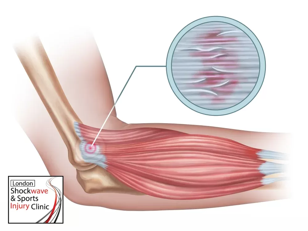 tennis lebow -what is it wimbledon shock wave clinic -focused 