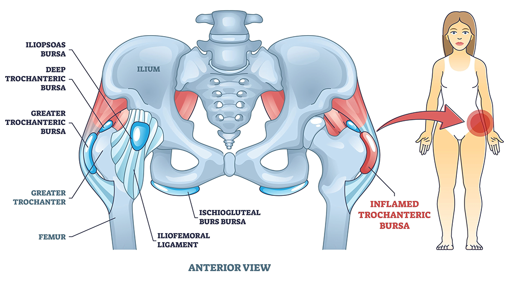How long does shock wave therapy for hip bursitis take?