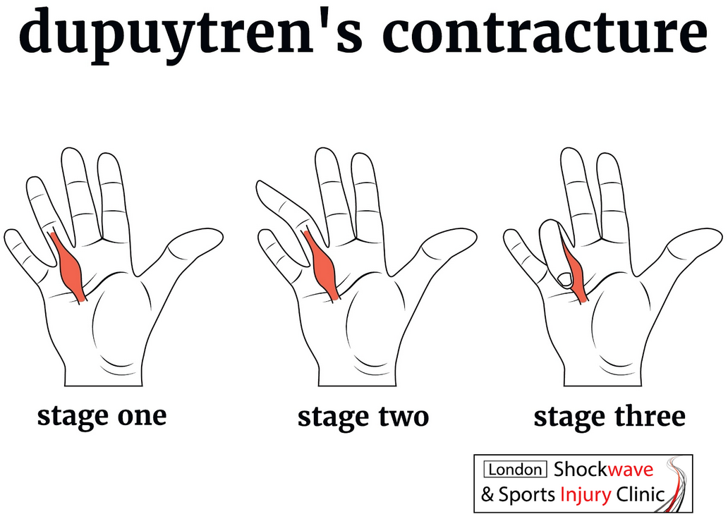 DUPUYTREN'S CONTRACTURE TREATMENT WITH SHOCK WAVE THERAPY IN WIMBLEDON LONDON