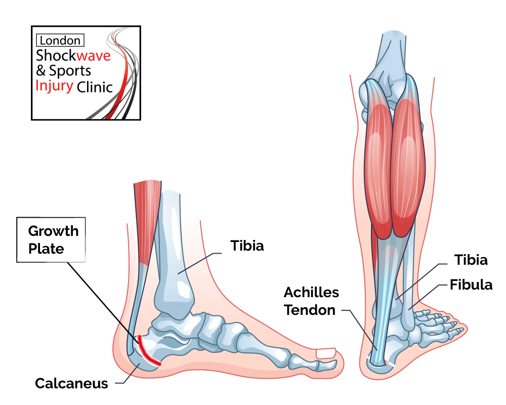 severs treatment with shock wave therapy in london